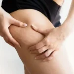 Reduza a celulite naturalmente: um chá de ervas simples para suavizar a sua pele