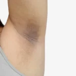 Como Clarear Axilas Escurecidas em Casa: Remédios Simples e Naturais