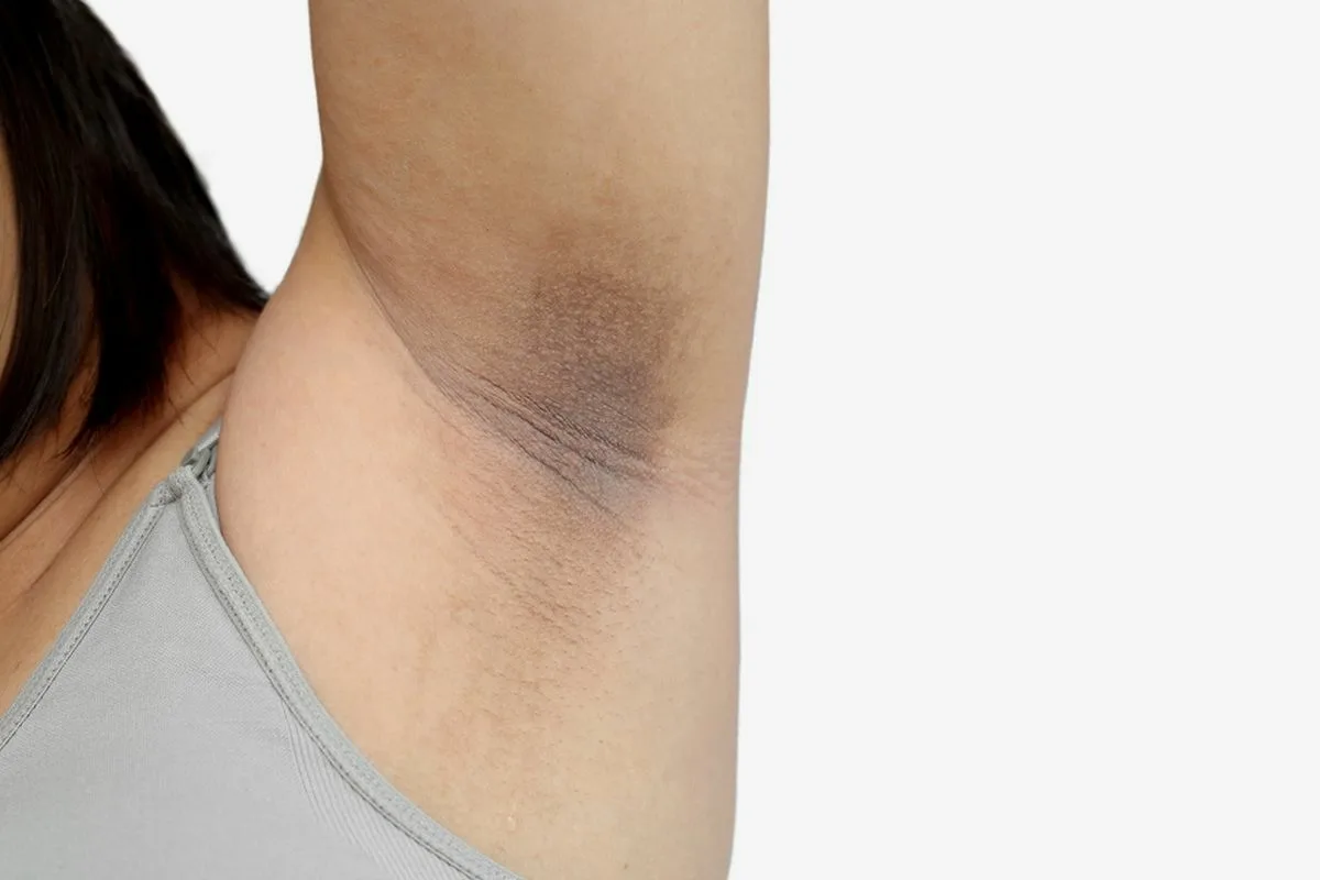 Como Clarear Axilas Escurecidas em Casa: Remédios Simples e Naturais